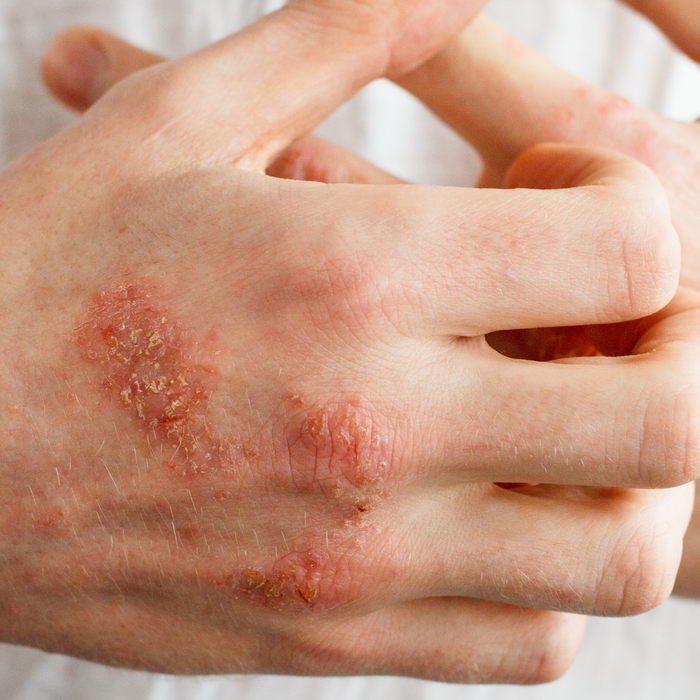 Eczema Relief: Simple Tips and Ingredients to Soothe Your Skin