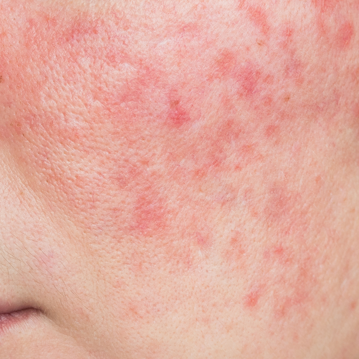 Managing Redness and Irritation From Rosacea: Tips, Triggers, and Ingredients to Know