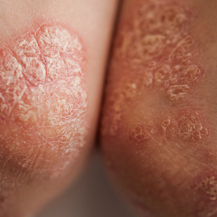 image of psoriasis plaques on the elbows