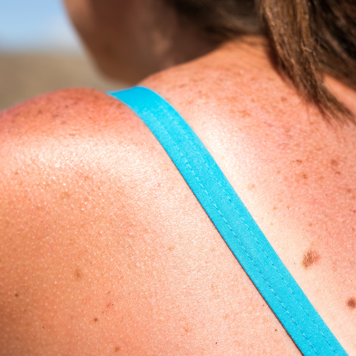 close up of woman in bathing suit's shoulder, showing sun damage, sunburn, and freckles